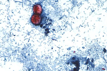 disease-caused-by-cyclospora-parasite-now-in-45-states:-cdc
