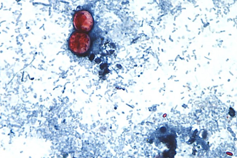 disease-caused-by-cyclospora-parasite-now-in-45-states:-cdc