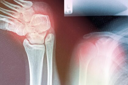 why-musculoskeletal-diseases-are-rising–and-how-to-address-the-root-causes