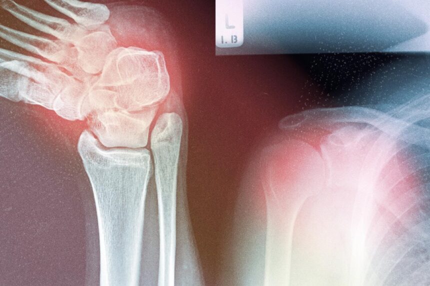 why-musculoskeletal-diseases-are-rising–and-how-to-address-the-root-causes