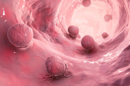 stiff-colon-tissue-linked-to-rising-cancer-cases-in-young-adults